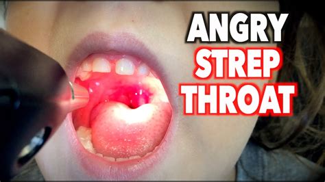 Angry Strep Throat After Antibiotics Dr Paul Youtube