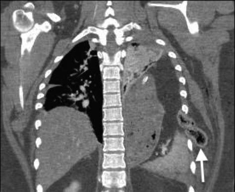 Traumatic Thoracic Rib Cage Hernias Operative Management And Proposal