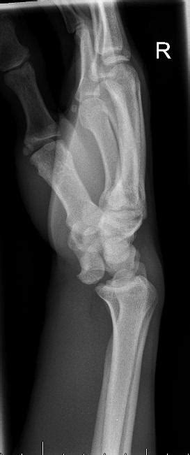 A Traumatic Wrist Injury The Bmj
