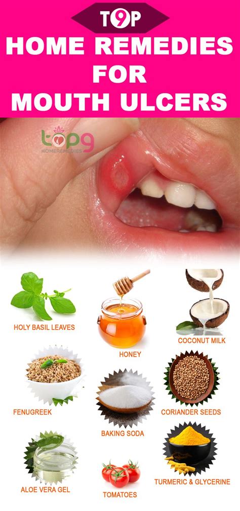 Top 9 Home Remedies For Mouth Ulcers Mouth Ulcers Canker Sore