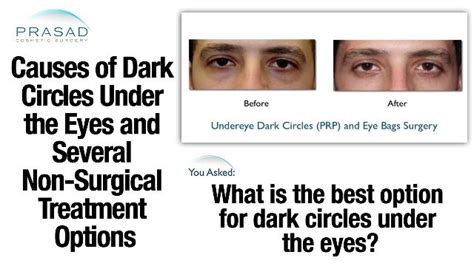 43 What Causes Dark Circles Under Your Eyes Pictures
