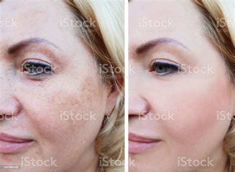 Girl Face Wrinkles Before And After Pigmentation Stock Photo Download