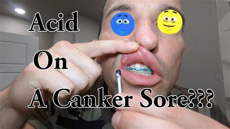 Brace Face Dealing With A Canker Sore Youtube