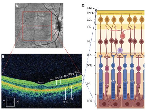 Ms Minute Retinal Optical Coherence Tomography For Ms Practical
