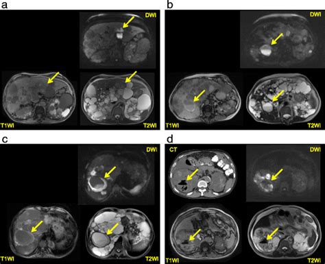 Intracystic Magnetic Resonance Imaging In Patients With Autosomal Dominant Polycystic Kidney