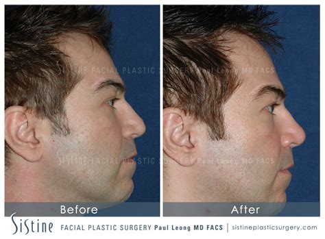 Dermal Fillers Before And After 37 Sistine Facial Plastic Surgery