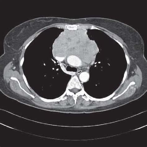 Computed Tomography Of The Thorax Showing A Mass In The Anterior