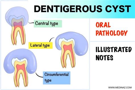 Dentigerous Cyst Oral Pathology Notes Medinaz Blog