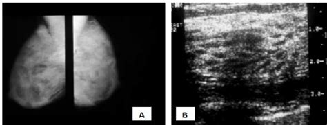 Normal Mammographic A And Ultrasound B Images Of Dense Breast