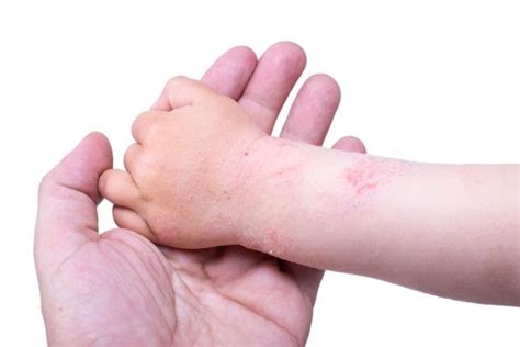 Dermatitis De Contacto Desencadenantes Y Tratamiento Ecoterapeuta