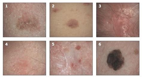 Examples Of Melanoma And Non Melanoma Skin Cancer Taken In A Clinical