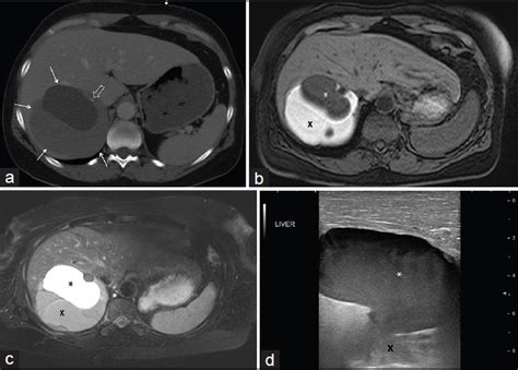 Mucinous Cystic Neoplasm Of The Liver Masquerading As An Echinococcal