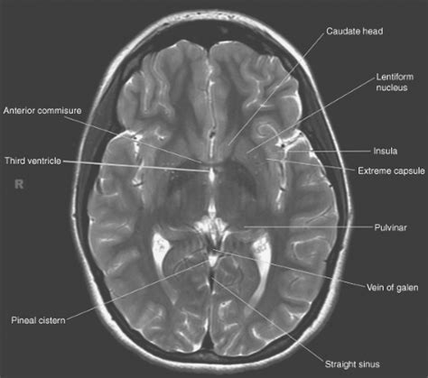 Introduction To Brain Imaging Radiology Key Free Nude Porn Photos