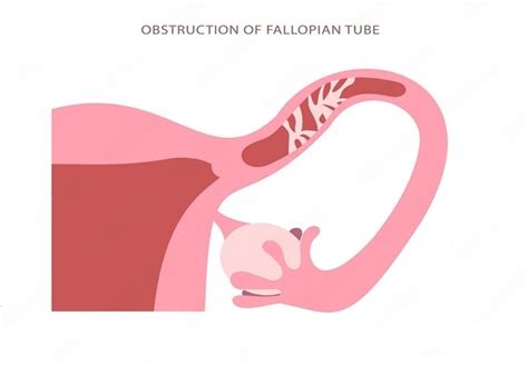 What Are The Fallopian Tube Blockage Treatment Options