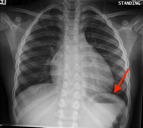 There are also important structures that are obscured or become visible. Radiological Anatomy: Stomach - Stepwards
