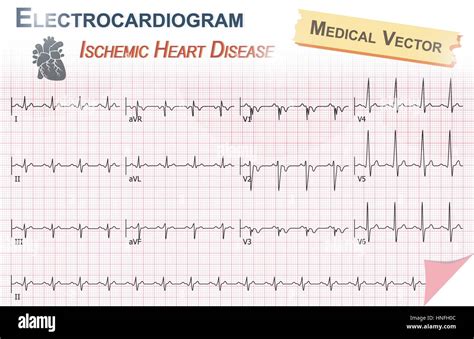 The Electrocardiogram Ecg For Cardiac Diagnosis