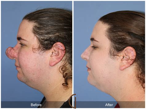 Before After Female Rhinoplasty Procedures In Newport Beach CA Orange County Facial Plastic