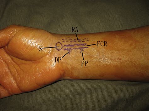 Endoscopic Ganglionectomy Of The Ganglion At The Volar Radial Side Of