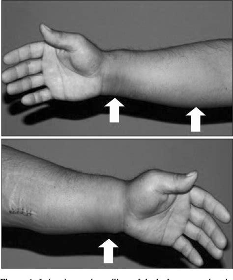 Figure 1 From Eosinophilic Fasciitis As The Initial Manifestation Of