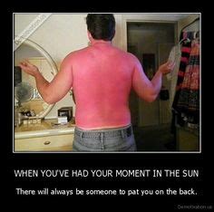 10 Best Bad Sunburns Images Bad Sunburn Funny Sunburn Tan Fail