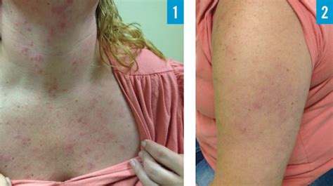 37 Year Old Female With Pruritic Rash On Upper Body The Doctors Channel