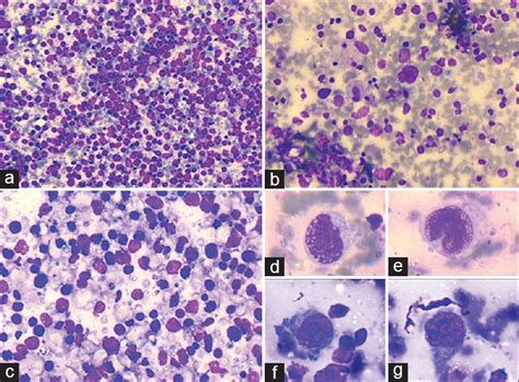 Primary Cutaneous Non Hodgkins Lymphoma Clinically Mimicking A Soft