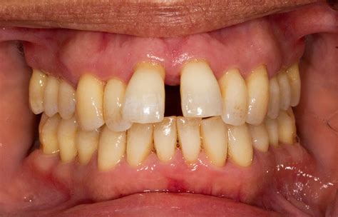 Gum Disease Symptoms And Treatment Cuckfield Dental