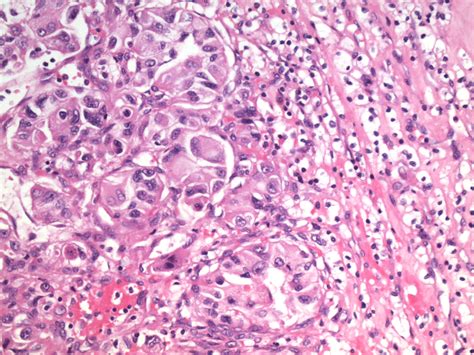 Renal Cell Carcinoma Pathology Image