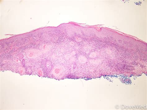 Metastatic Squamous Cell Carcinoma Of Skin