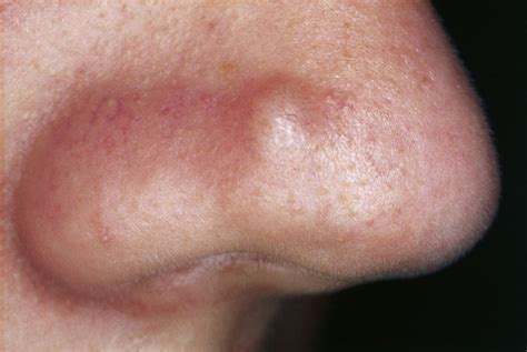 Treating Acne With Laser Therapy Can It Benefit You