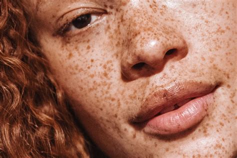 Understanding The Causes Of Fading Freckles And How To Restore Them