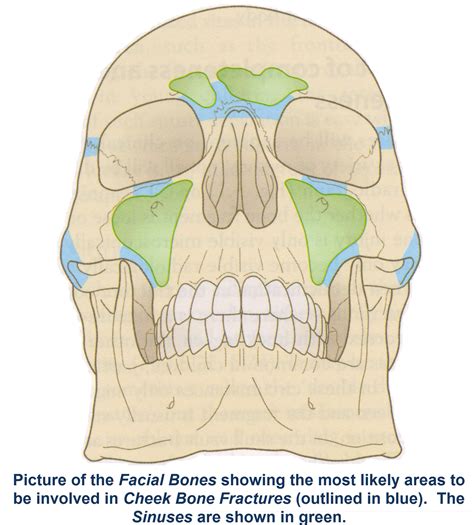 Fractures Of The Cheek Bone Zygomatic Complex Exodontia
