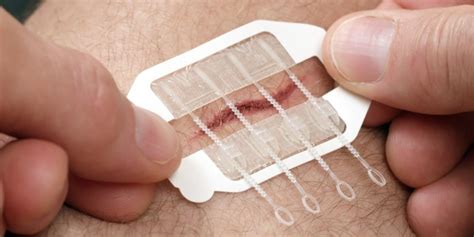 Zipstitch Laceration Kit Is The Latest Thing In Wound Repair Technology