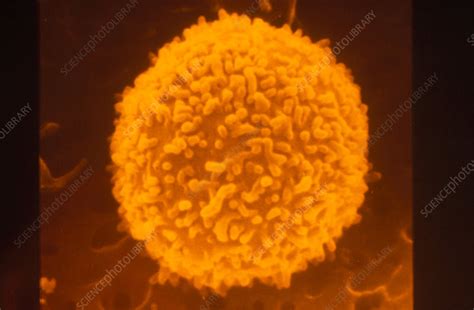 Sem Of White Blood Cells Of Person With Leukaemia Stock Image M132