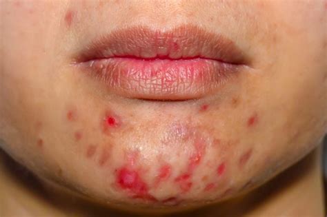 How To Treat Different Types Of Acne Readers Digest