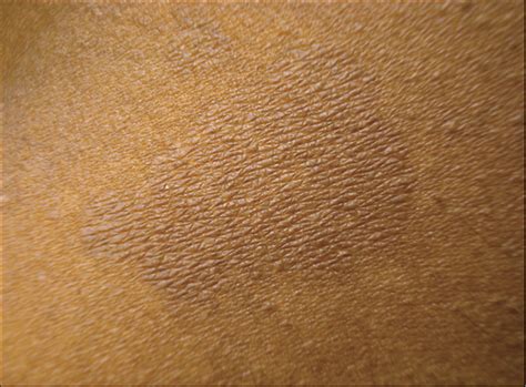 Evoked Scale Sign Of Tinea Versicolor Dermatology Jama Dermatology