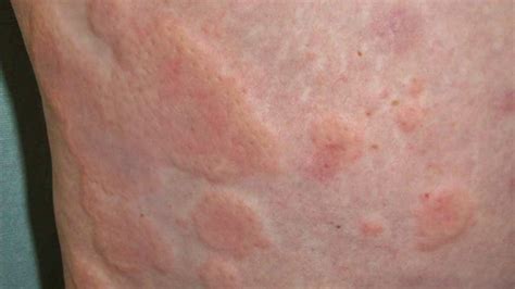 Skin Rashes That Itch Lines Rekasense