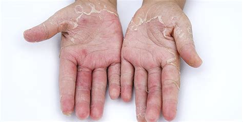 Home Remedy To Get Rid Of Hand Skin Peeling Home Remedies For Skin