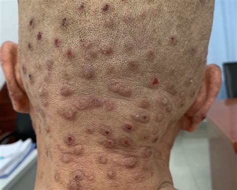 A 64 Year Old Man With 15 Year History Of Prurigo Nodularis 64岁罹患结节性痒疹