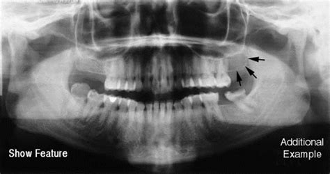 Dental Radiography Anatomical Landmarks Pan Flashcards Quizlet