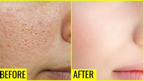 Open Pores Solution At Home For Oily Skin