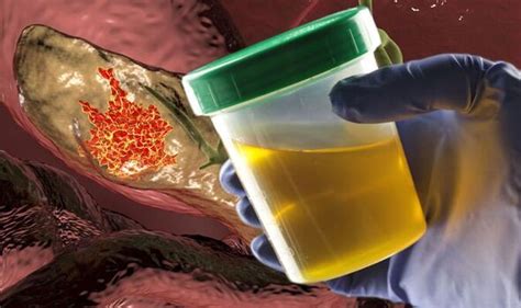 Pancreatic Cancer Brown Urine May Be Among First Symptoms Uk