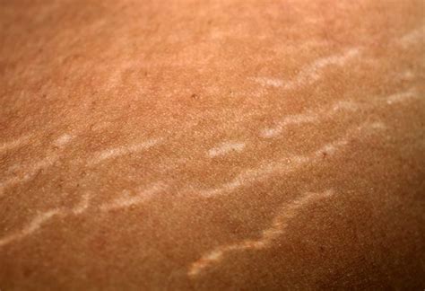 What Causes Stretch Marks Facty Health