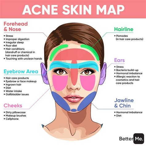Proskin Laser And Aesthetics On Instagram “this Is What Acne Says About