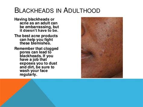 Common Blackhead Causes