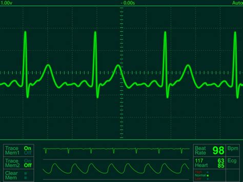 Interfacing Electrocardiogram Ecg With Iot Intel Devmesh