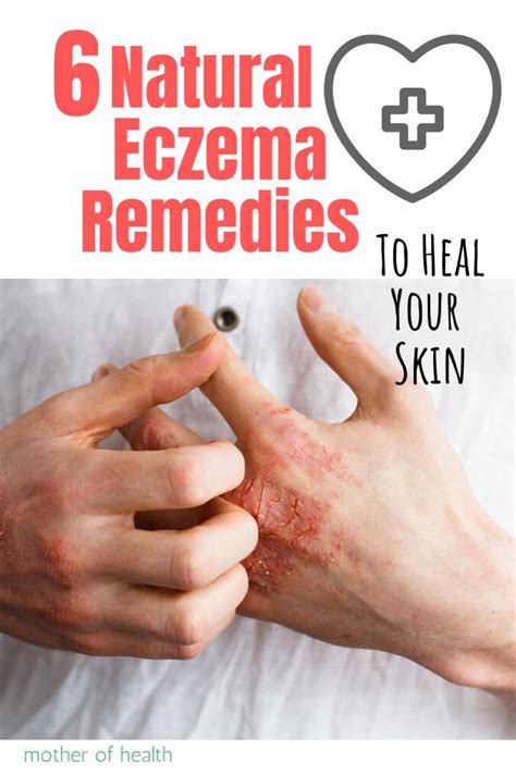 6 Natural Eczema Remedies To Heal Your Skin Mother Of Health