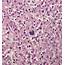 Pathology Outlines  Mixed Cellularity Classic Hodgkin Lymphoma
