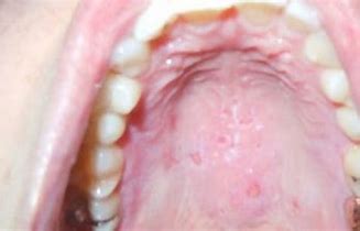 One has redness around it answered by dr. Can i see a picture of canker sores on the roof of mouth ...