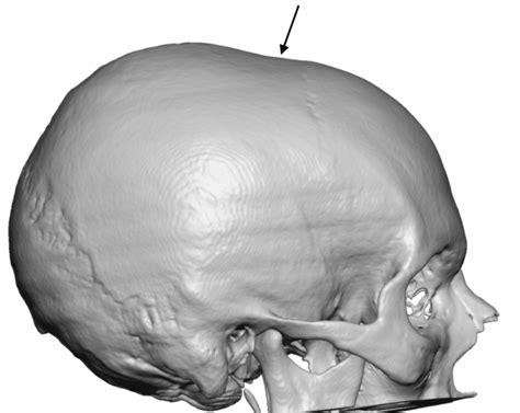 Coronal Dip Skull Defect Side View 3d Ct Scan Dr Barry Eppley